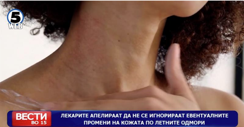 Лекарите апелираат да не се игнорираат евентуалните промени на кожата по летните одмори